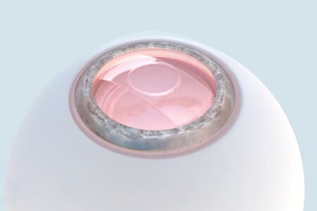 依鏡PRL晶體植入術(shù)注意事項(xiàng)，尤其第二步！